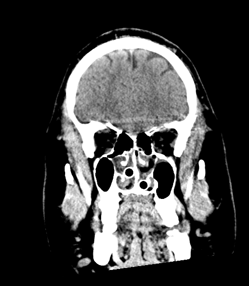 Brainstem hemorrhage (Radiopaedia 81294-94976 Coronal non-contrast 16).jpg
