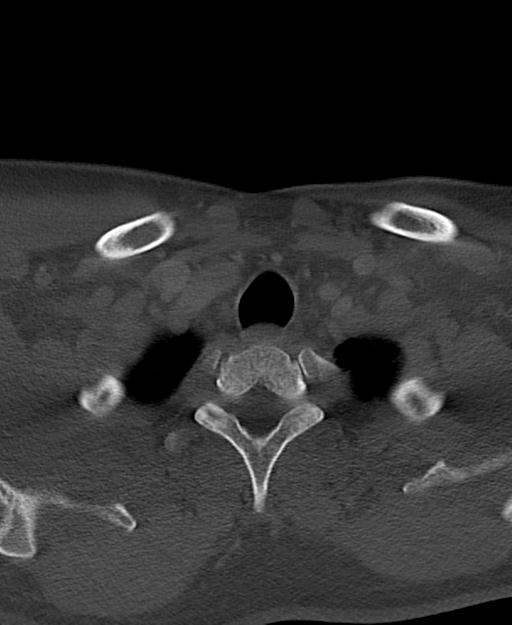 Branchial cleft cyst (Radiopaedia 31167-31875 Axial bone window 68).jpg