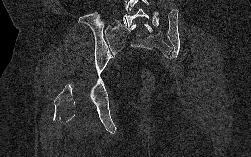 Breast carcinoma with pathological hip fracture (Radiopaedia 60314-67993 Coronal bone window 82).jpg