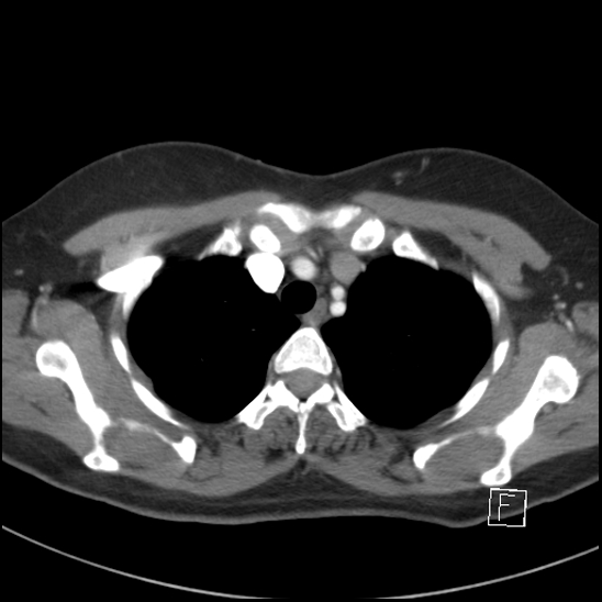 File:Breast metastases from renal cell cancer (Radiopaedia 79220-92225 A 19).jpg