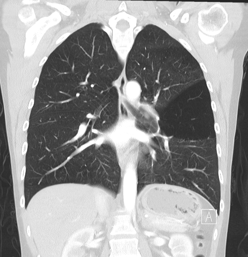 File:Bronchial atresia (Radiopaedia 73677-84470 Coronal lung window 20).jpg