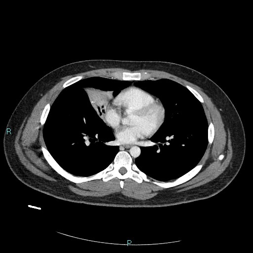 Bronchial carcinoid tumor (Radiopaedia 78272-90875 A 57).jpg
