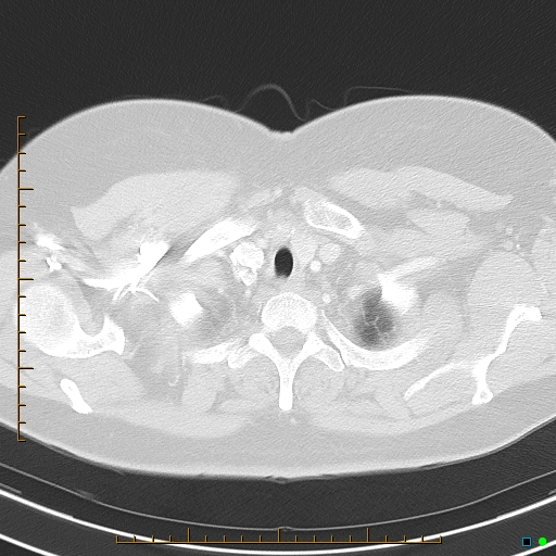Bronchial diverticula (Radiopaedia 79512-92675 Axial lung window 5).jpg