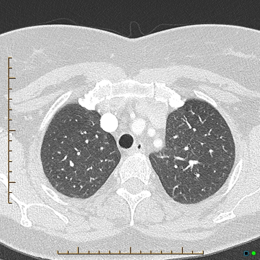 Bronchial diverticula (Radiopaedia 79512-92676 Axial lung window 31).jpg