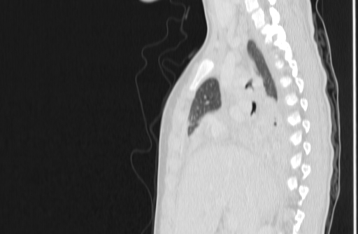 Bronchial mucoepidermoid carcinoma (Radiopaedia 57023-63895 Sagittal lung window 56).jpg