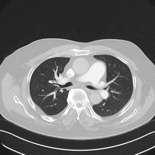 Bronchiectasis (Radiopaedia 39385-41666 Axial lung window 28).png