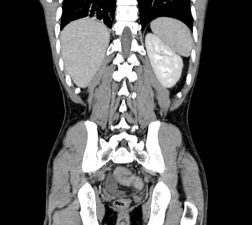 File:Bronchiectasis in Crohn disease (Radiopaedia 60311-67977 C 66).jpg