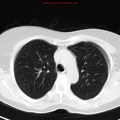 File:Bronchoalveolar carcinoma (BAC) (Radiopaedia 13436-13392 Axial lung window 16).jpg