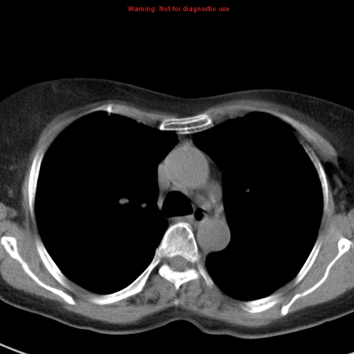 File:Bronchoalveolar carcinoma (BAC) (Radiopaedia 13436-13392 Axial non-contrast 19).jpg
