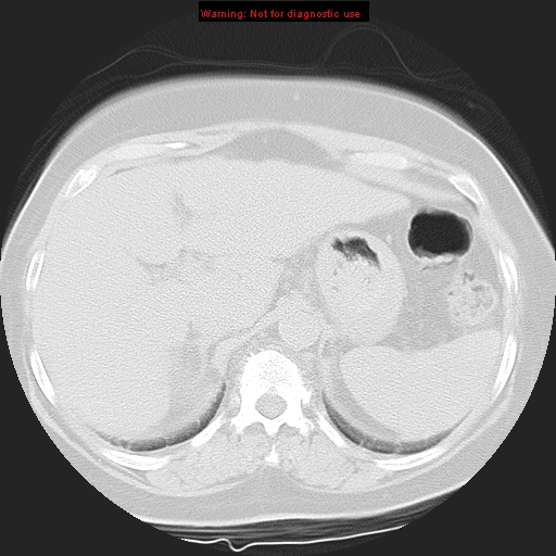 Bronchoalveolar carcinoma (Radiopaedia 13224-13233 Axial lung window 46).jpg
