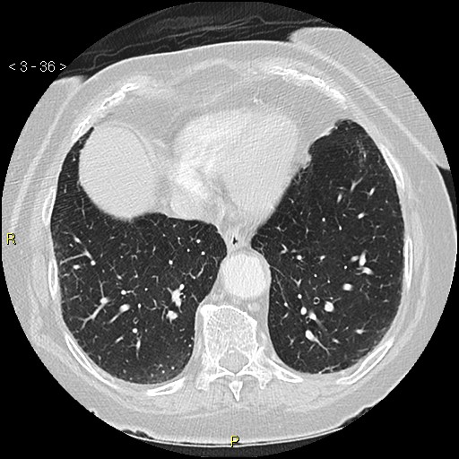 File:Bronchogenic carcinoma as an incidental finding (Radiopaedia 16453-16130 Axial lung window 36).jpg