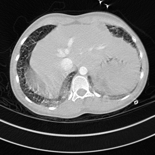 Bronchogenic cyst (Radiopaedia 77801-90071 Axial lung window 77).jpg
