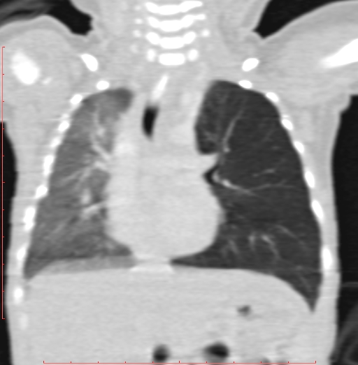 Bronchogenic cyst (Radiopaedia 78599-91409 Coronal lung window 116).jpg