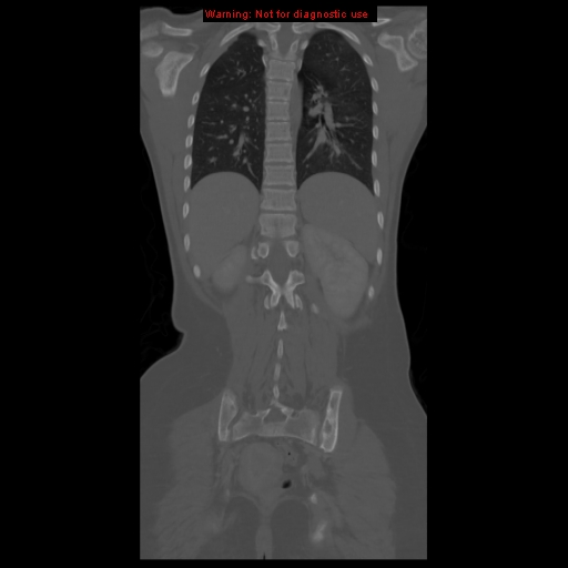 File:Brown tumor (Radiopaedia 12318-12596 D 48).jpg