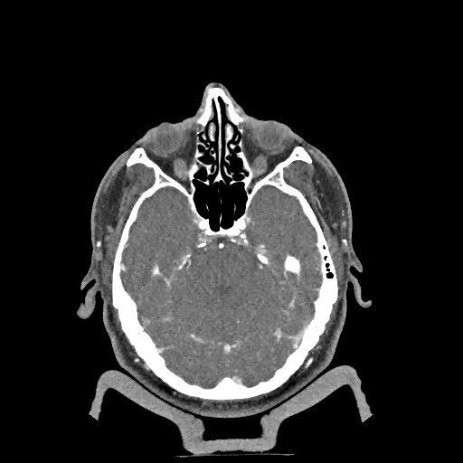 Buccal fat pad arteriovenous malformation (Radiopaedia 70936-81144 D 270).jpg