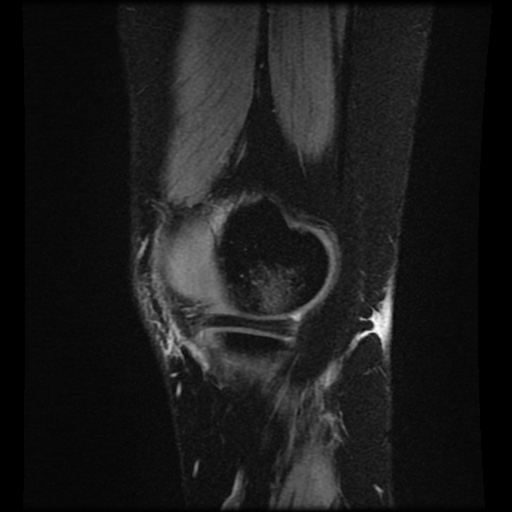 Bucket handle meniscus tear (Radiopaedia 56916-63751 H 74).jpg