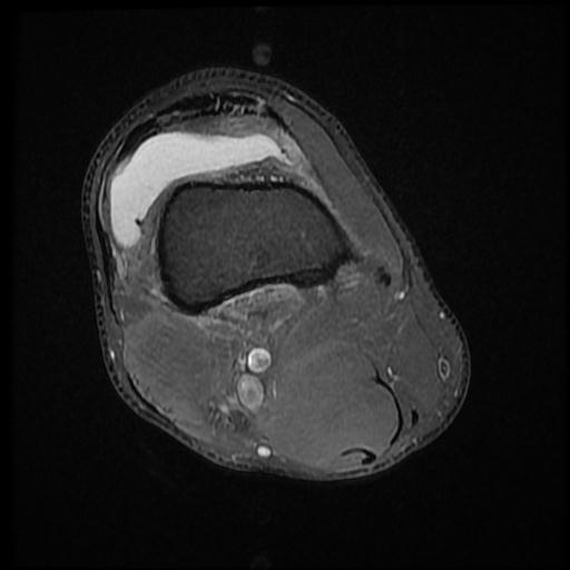 File:Bucket handle tear - medial meniscus (Radiopaedia 69245-79026 Axial PD fat sat 2).jpg