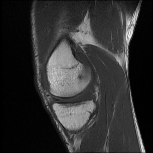 File:Bucket handle tear - medial meniscus (Radiopaedia 69245-79026 Sagittal T1 13).jpg