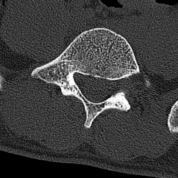 Burst fracture (Radiopaedia 53373-59357 Axial bone window 59).jpg
