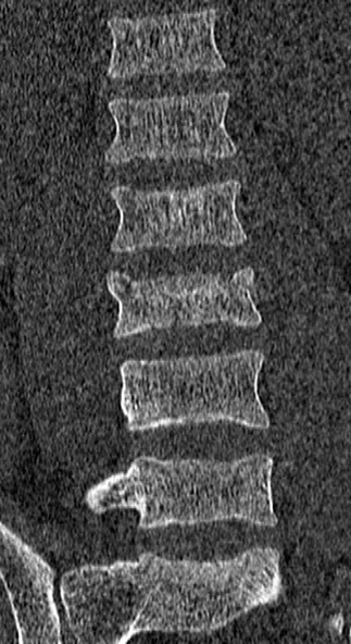 Burst fracture (Radiopaedia 53373-59357 Coronal bone window 30).jpg
