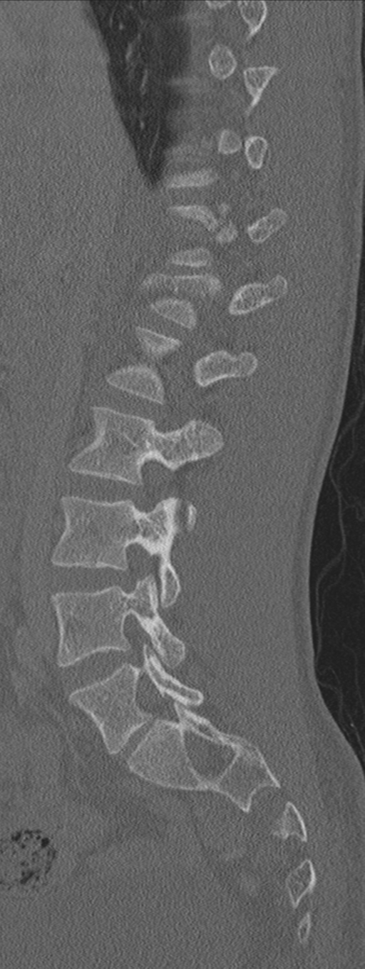 Burst fracture - T12 with conus compression (Radiopaedia 56825-63647 Sagittal bone window 54).png
