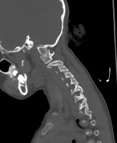 File:Butterfly vertebra (Radiopaedia 77903-90209 Sagittal bone window 83).jpg