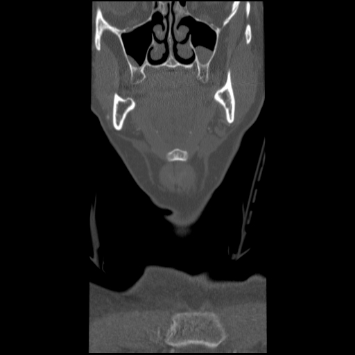 C1 anterior arch (plough) fracture - type 1 (Radiopaedia 76181-87720 Coronal bone window 93).jpg