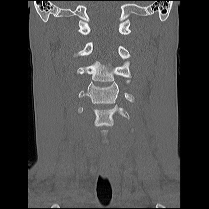 C5 facet fracture (Radiopaedia 58374-65499 Coronal bone window 26).jpg