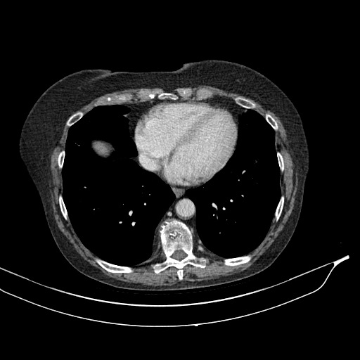 Calcified adrenal glands and Spigelian hernia (Radiopaedia 49741-54988 A 5).jpg