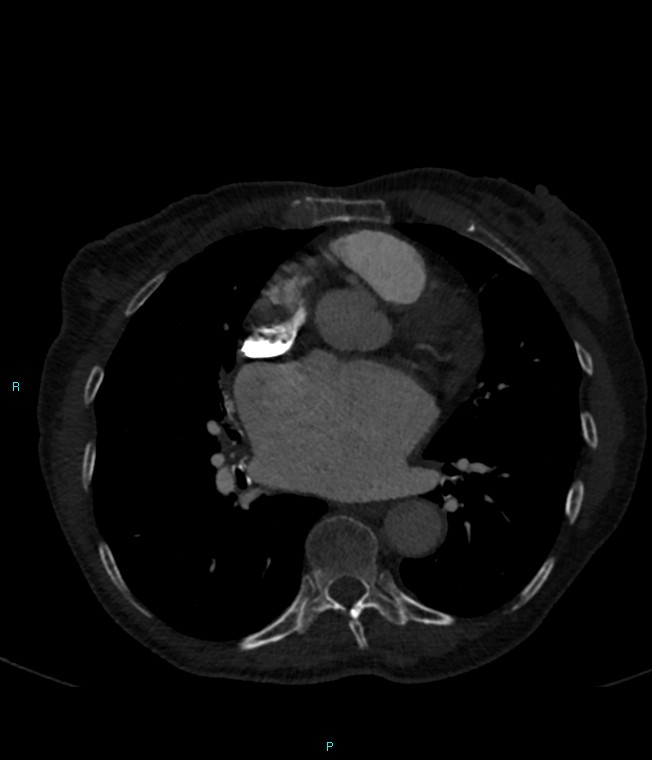 Calcified cerebral emboli from left ventricular thrombus (Radiopaedia 84420-99760 Axial bone window 48).jpg