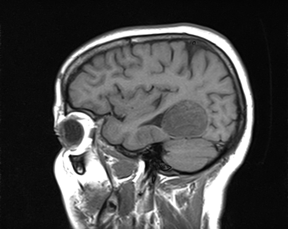 File:Calcified cerebral hydatid cyst (Radiopaedia 65603-74699 Sagittal T1 5).jpg