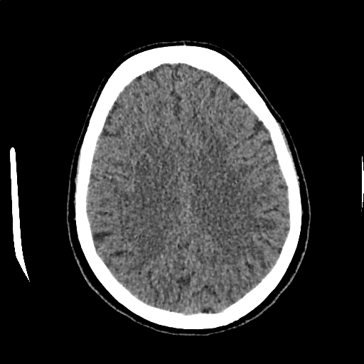 File:Calcified cerebral hydatid cyst (Radiopaedia 65603-74717 Axial non-contrast 53).jpg