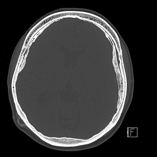 Calcified chronic subdural hematoma (Radiopaedia 77374-89492 Axial bone window 67).jpg