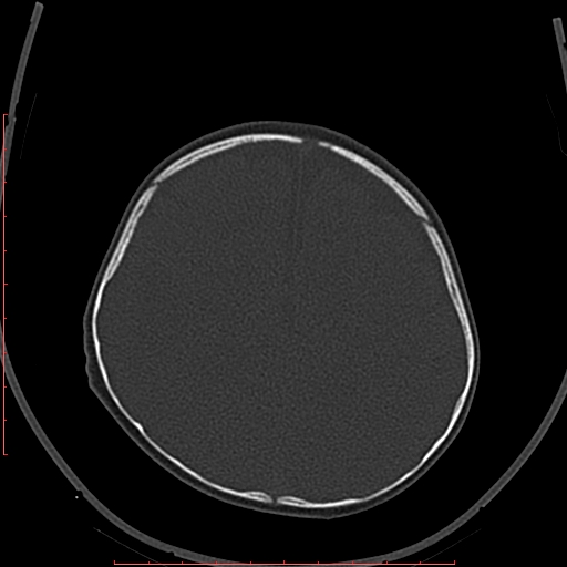 File:Calcified middle cerebral artery embolism (Radiopaedia 78949-91860 Axial bone window 54).jpg