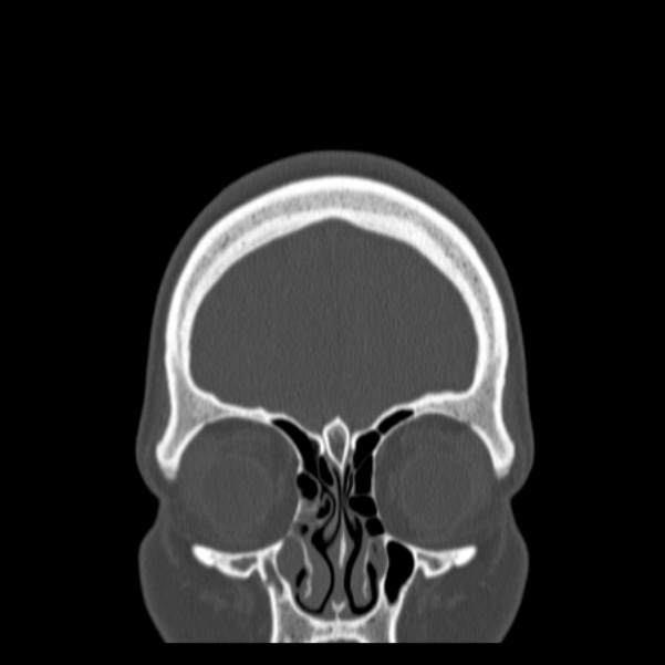 Calvarial osteoma (Radiopaedia 36520-38079 C 17).jpg