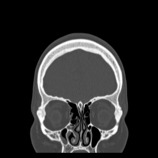 Calvarial osteoma (Radiopaedia 36520-38079 C 19).jpg