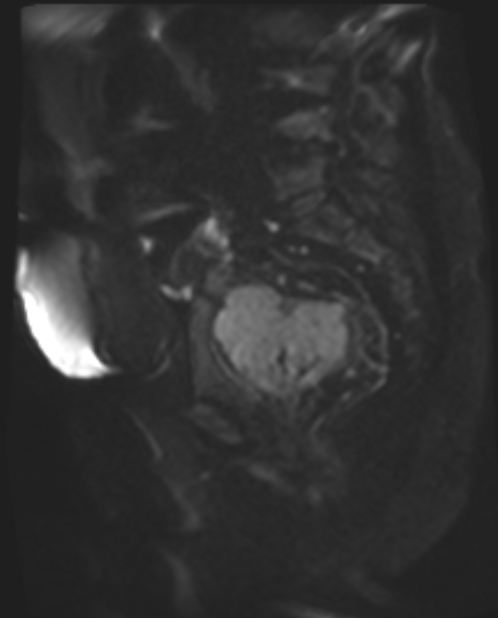 Cancer cervix - stage IIb (Radiopaedia 75411-86615 Sagittal DWI 60).jpg