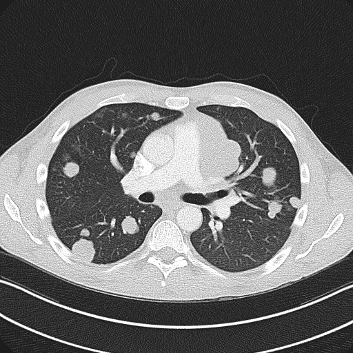 Cannonball metastases - testicular choriocarcinoma (Radiopaedia 84510-99891 Axial lung window 46).jpg