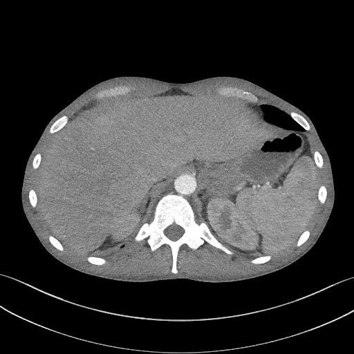 Cannonball metastases - testicular choriocarcinoma (Radiopaedia 84510-99891 B 100).jpg