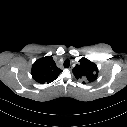 Cannonball metastases - testicular choriocarcinoma (Radiopaedia 84510-99891 B 28).jpg