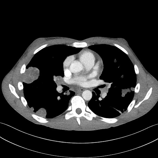 Cannonball metastases - testicular choriocarcinoma (Radiopaedia 84510-99891 B 61).jpg