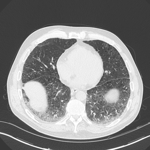 Caplan syndrome (Radiopaedia 56667-63530 Axial lung window 134).jpg