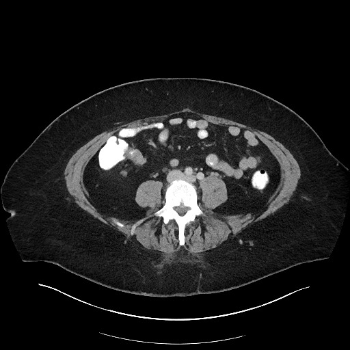 Carcinoid tumor - terminal ileum (Radiopaedia 60931-68739 A 82).jpg