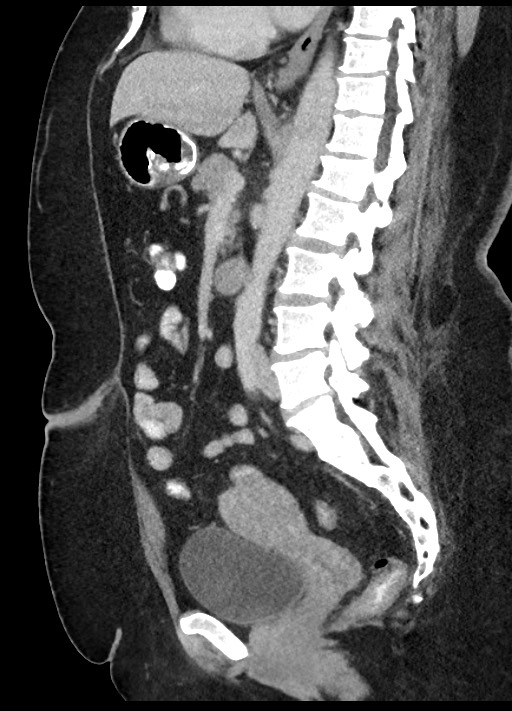 Carcinoid tumor - terminal ileum (Radiopaedia 60931-68739 C 45).jpg