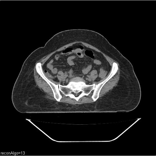 File:Carcinoma cervix- brachytherapy applicator (Radiopaedia 33135-34173 Axial non-contrast 8).jpg
