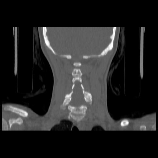 Carcinoma of the maxillary antrum (Radiopaedia 53805-59888 Coronal bone window 119).jpg