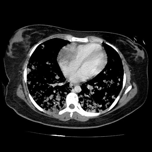 File:Cardiac angiosarcoma (Radiopaedia 66010-75181 B 107).jpg