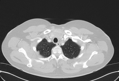 Cardiac sarcoidosis (Radiopaedia 74548-85534 Axial lung window 10).jpg