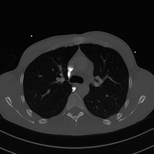 Cardiac tumor - undifferentiated pleomorphic sarcoma (Radiopaedia 45844-50134 Axial bone window 25).png