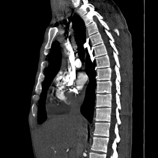 Cardiac tumor - undifferentiated pleomorphic sarcoma (Radiopaedia 45844-50134 B 44).png